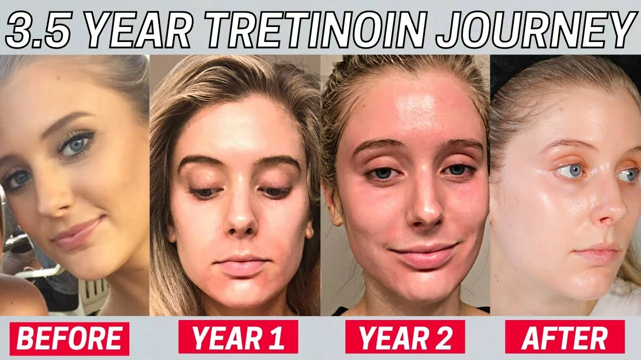How long does it take to see results with tretinoin?